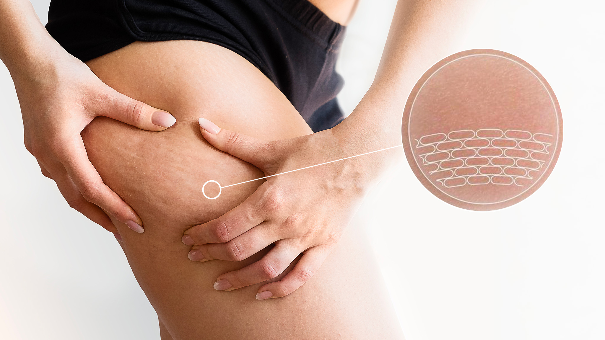 Cellulite, le creme non funzionano? Ecco cosa usare a casa per eliminarla