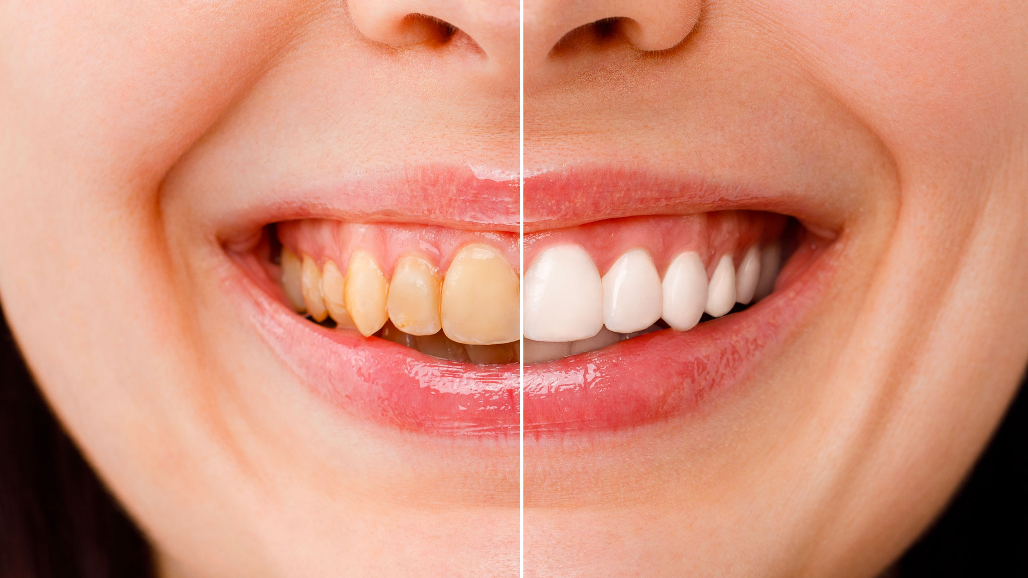 Denti gialli: ecco i migliori prodotti per sbiancarli a casa!